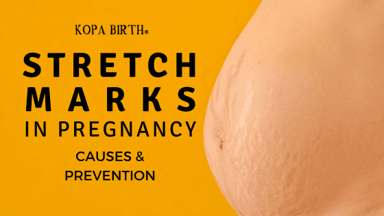 Stretch marks in pregnancy - causes & prevention - image